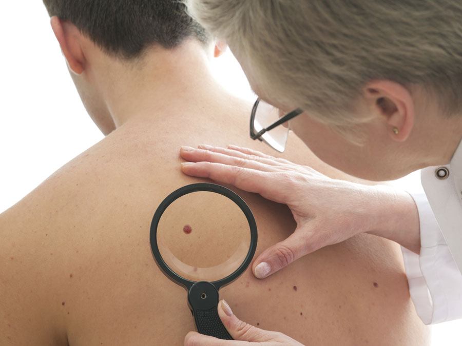 OJO CON EL  SOL. Consejos para la prevención del cáncer de piel
