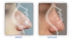 rinoplastia en hombre