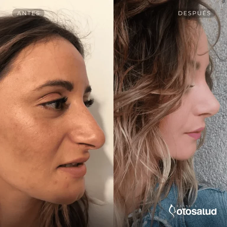 Rinoplastia. Antes y Después
