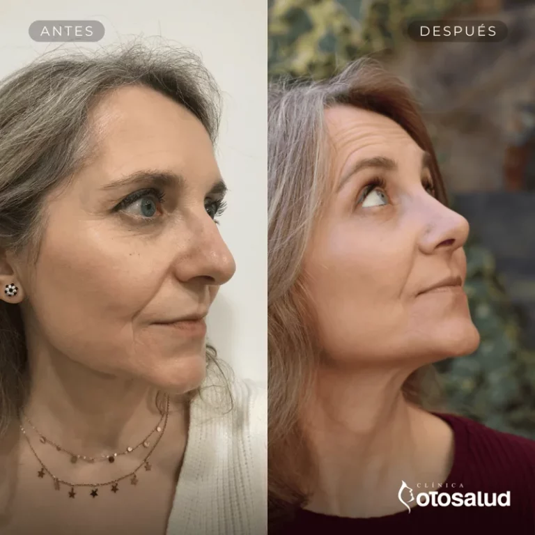 Rinoplastia. Antes y Después