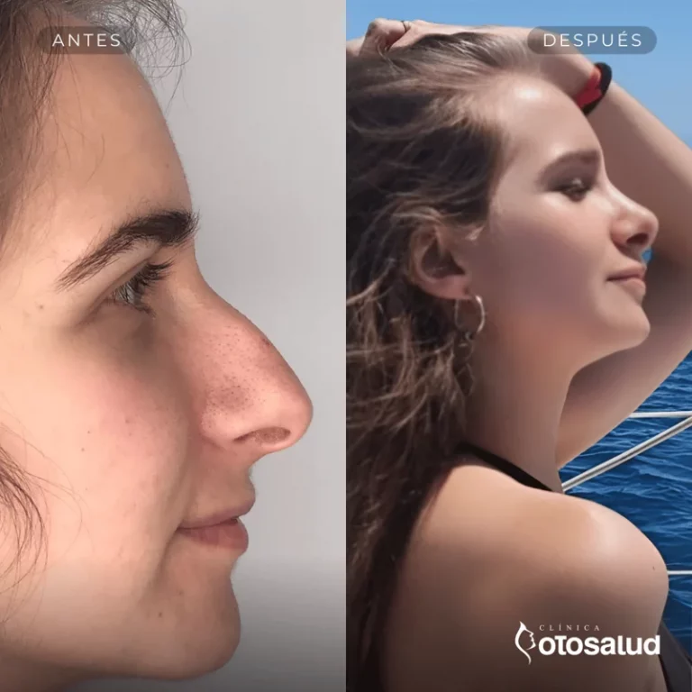 Rinoplastia. Antes y Después