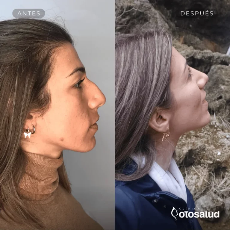 Rinoplastia. Antes y Después