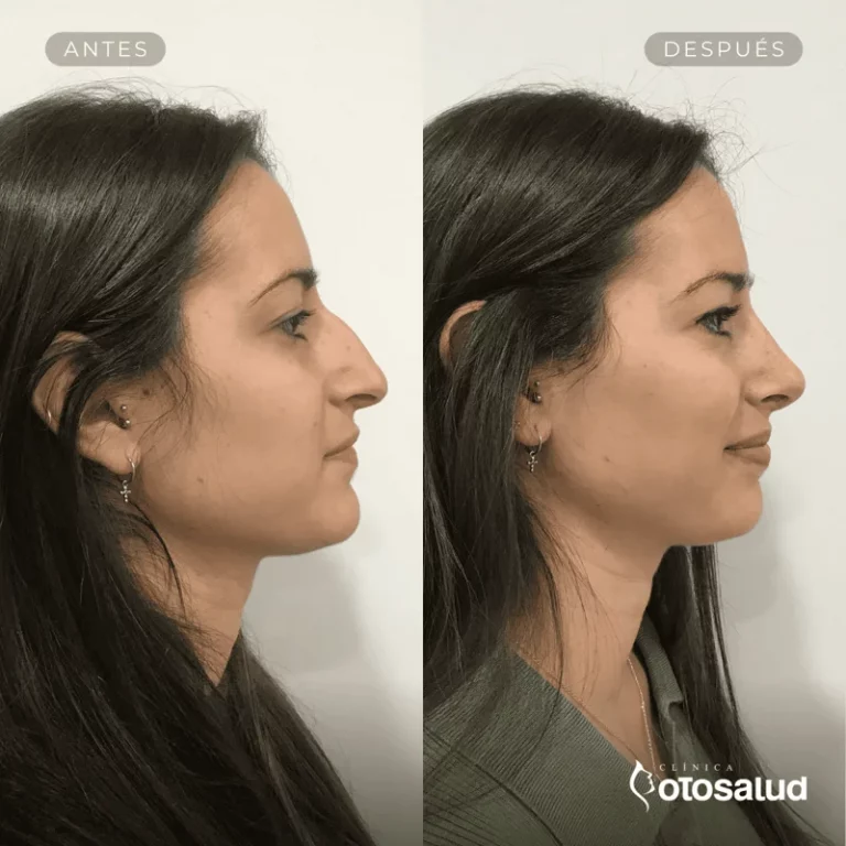 Rinoplastia. Antes y Después
