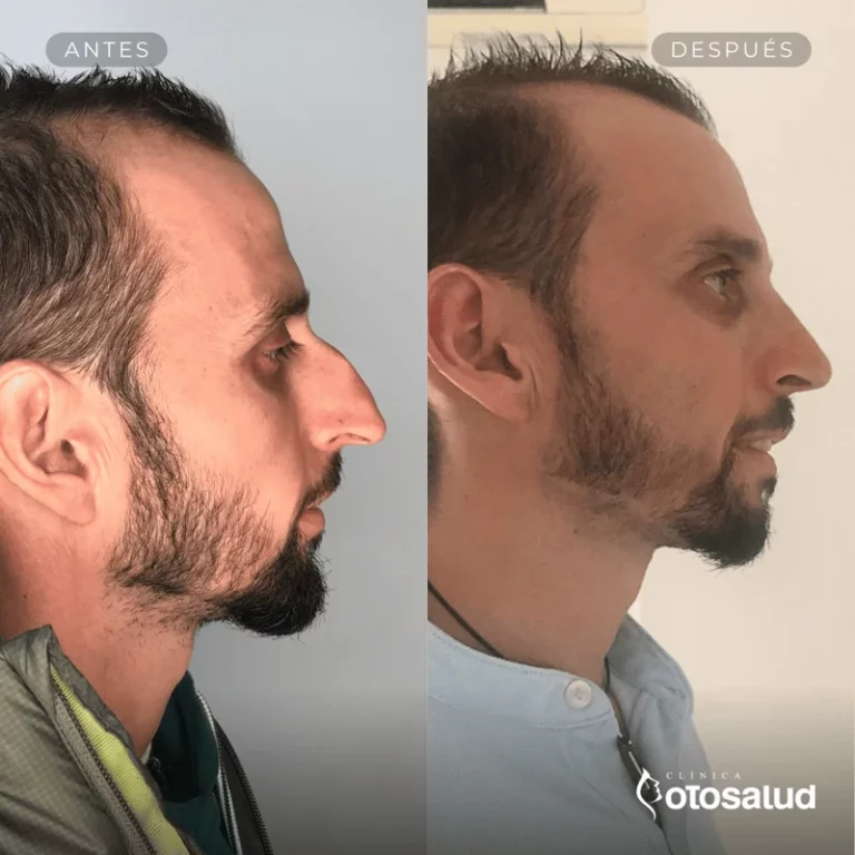 Rinoplastia. Antes y Después