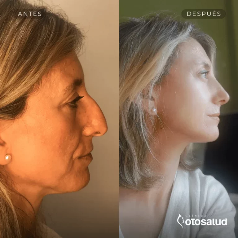 Rinoplastia. Antes y Después