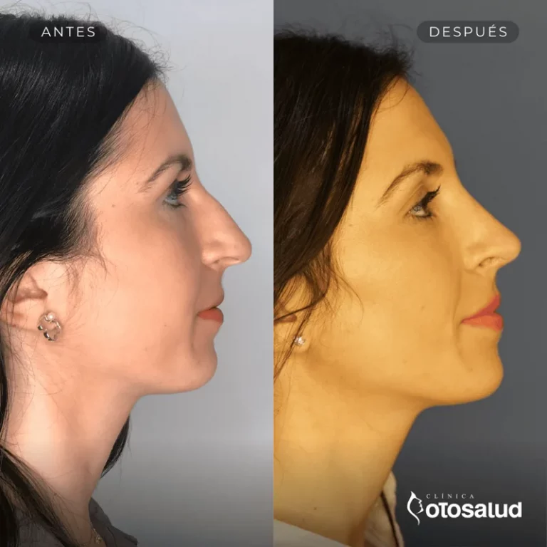 Rinoplastia. Antes y Después