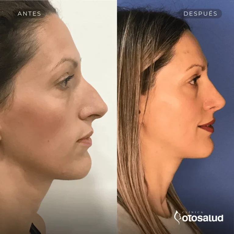 Rinoplastia. Antes y Después