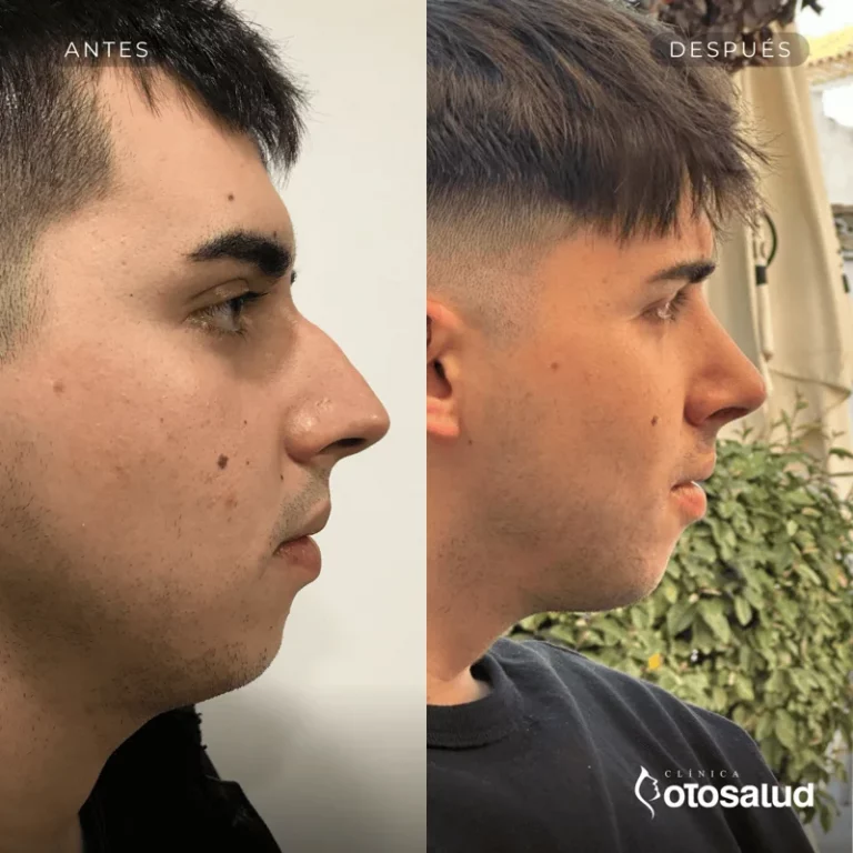 Rinoplastia. Antes y Después