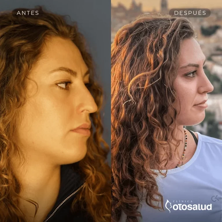Rinoplastia. Antes y Después