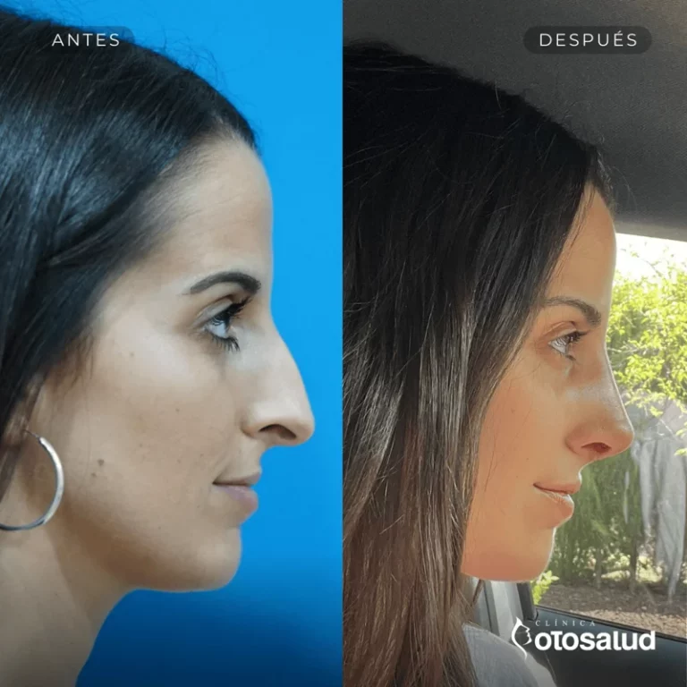 Rinoplastia. Antes y Después