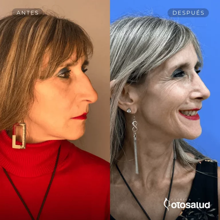 Rinoplastia. Antes y Después