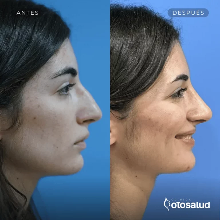 Rinoplastia. Antes y Después