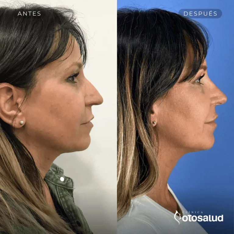 Rinoplastia. Antes y Después
