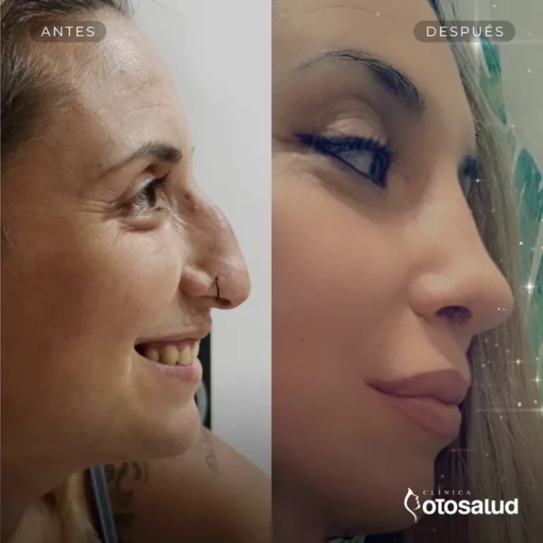 Rinoplastia. Antes y Después