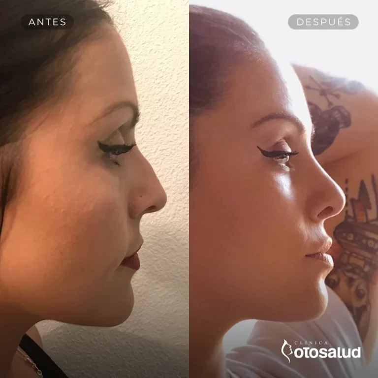 Rinoplastia. Antes y Después