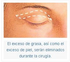 El exceso de grasa, así como el exceso de piel, serán eliminados durante la cirugía