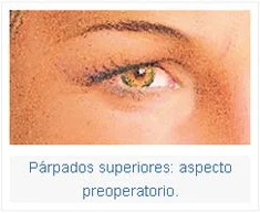 Párpados superiores, aspecto preoperatorio