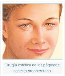 Párpados superiores, aspecto preoperatorio