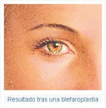 Blefaroplastia superior, resultado