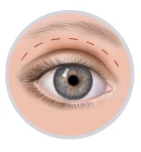 Blefaroplastia superior