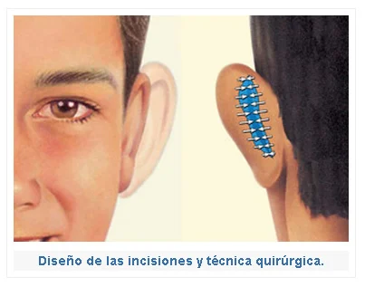 Otoplastia. Diseño de las incisiones y técnica quirurgica