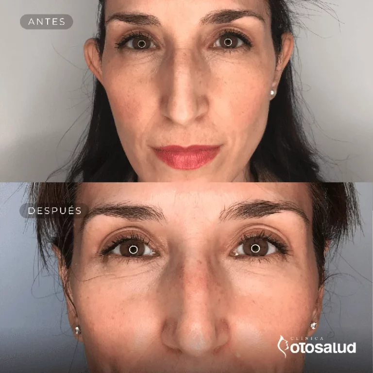 Otoplastia. Antes y Después