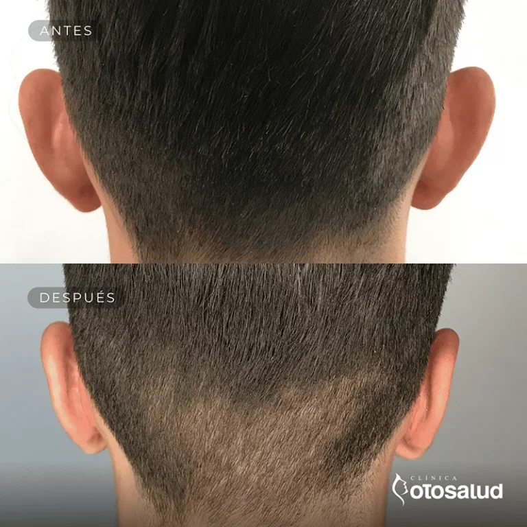 Otoplastia. Antes y Después