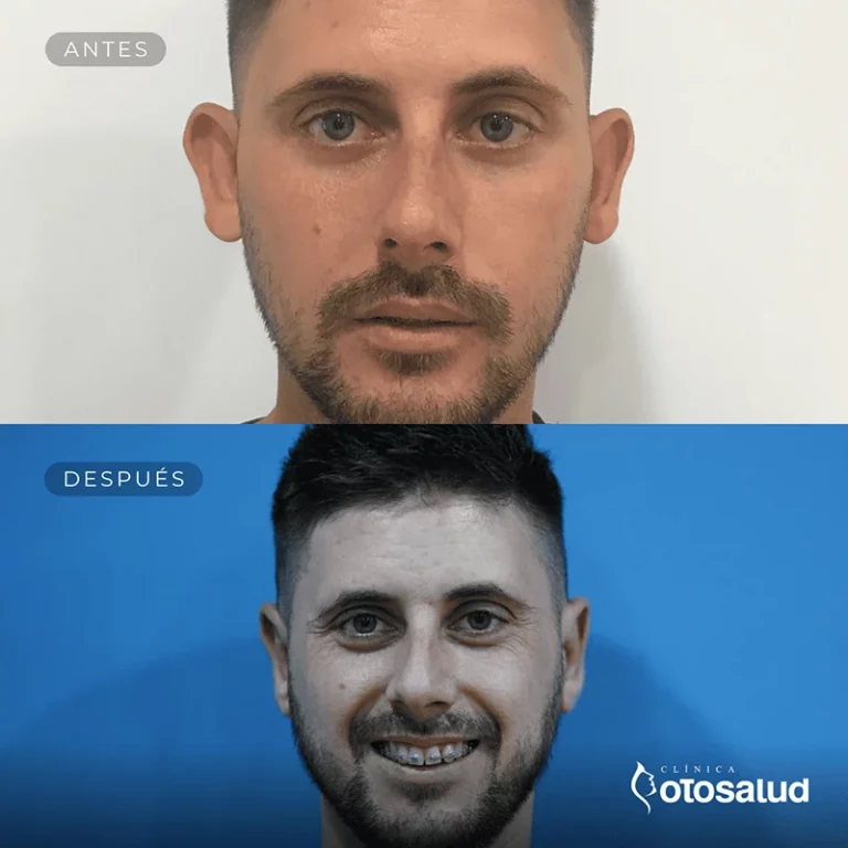 Otoplastia. Antes y Después