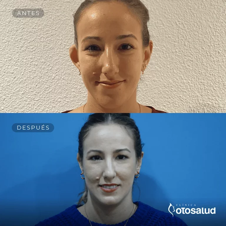 Otoplastia. Antes y Después