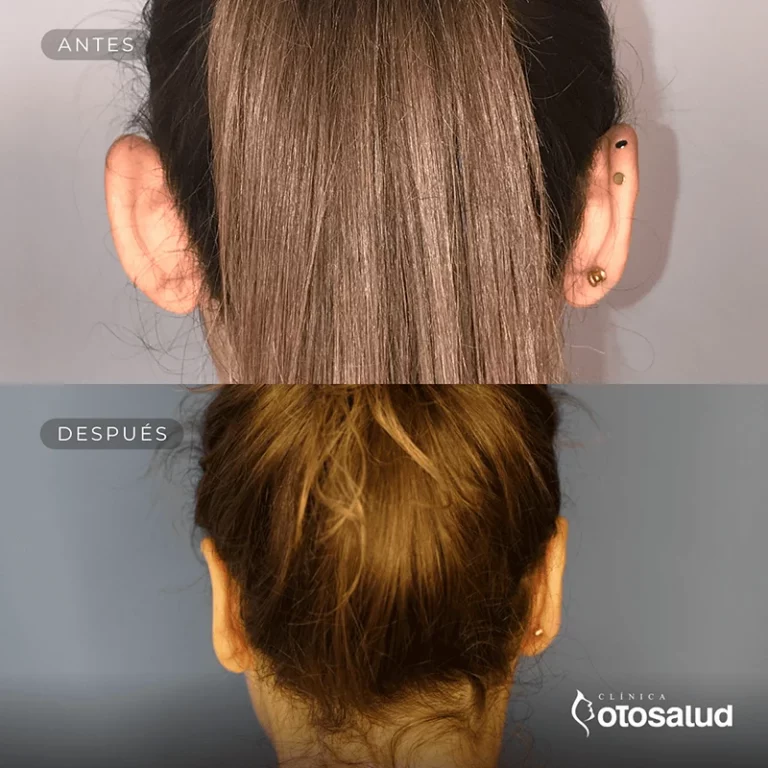 Otoplastia. Antes y Después