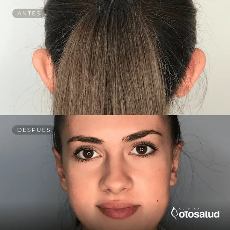 Otoplastia. Antes y Después