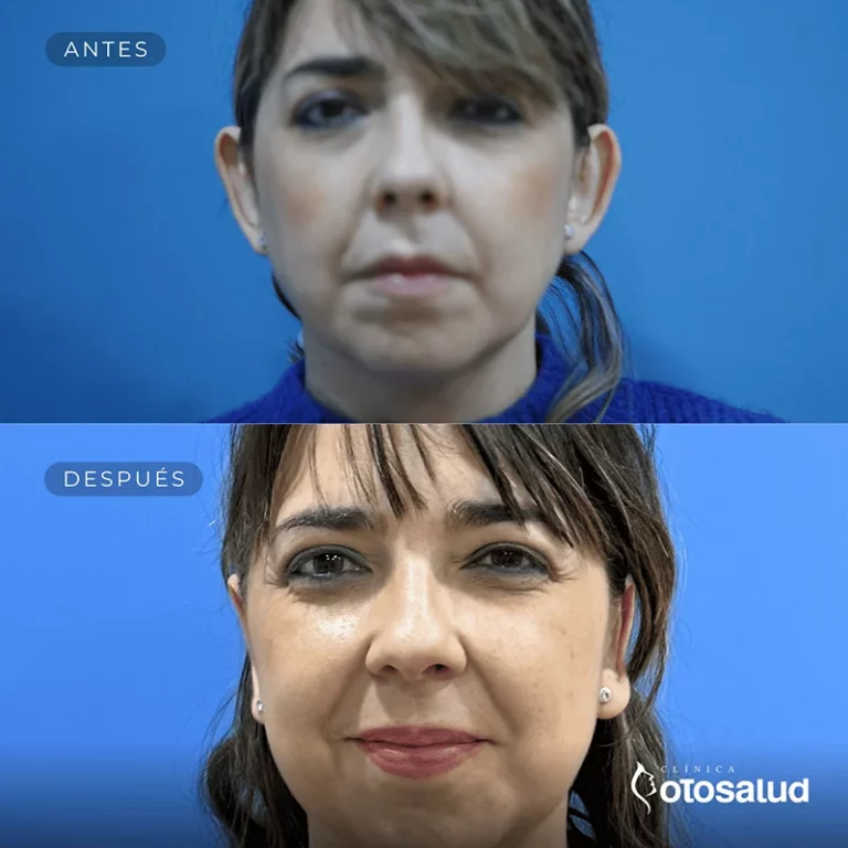 Otoplastia. Antes y Después