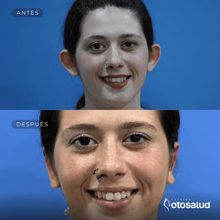 Otoplastia. Antes y Después