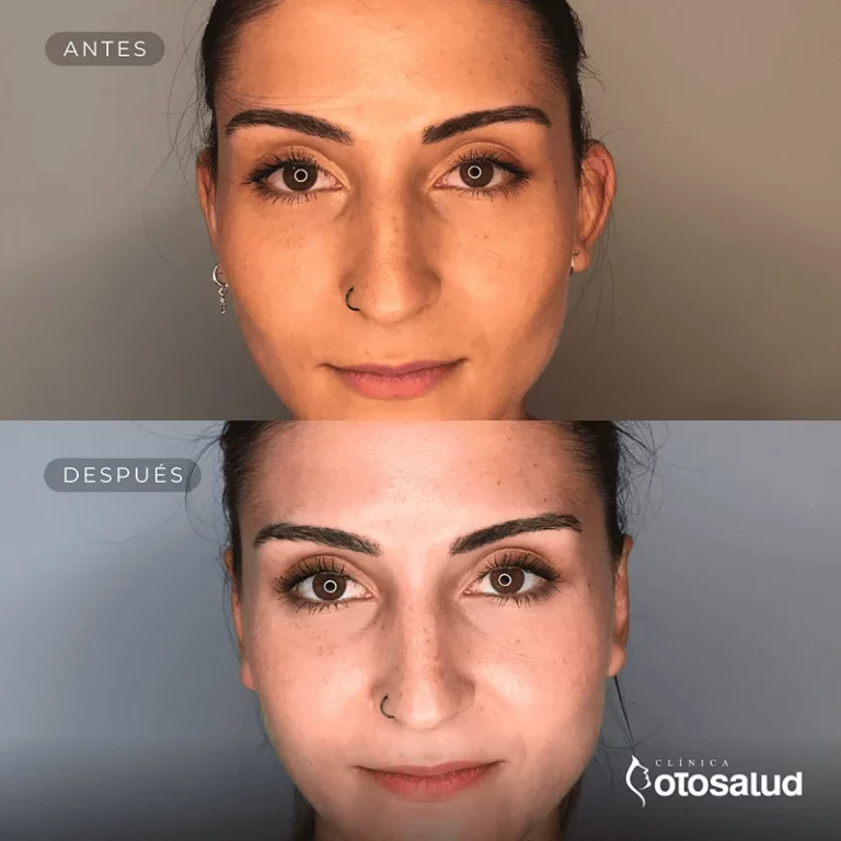 Otoplastia. Antes y Después