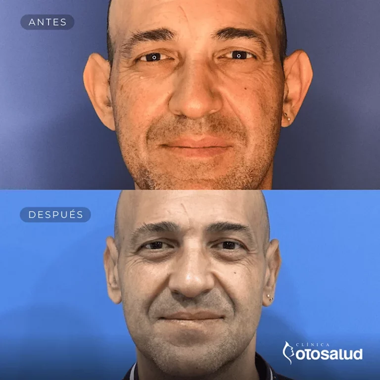 Otoplastia. Antes y Después
