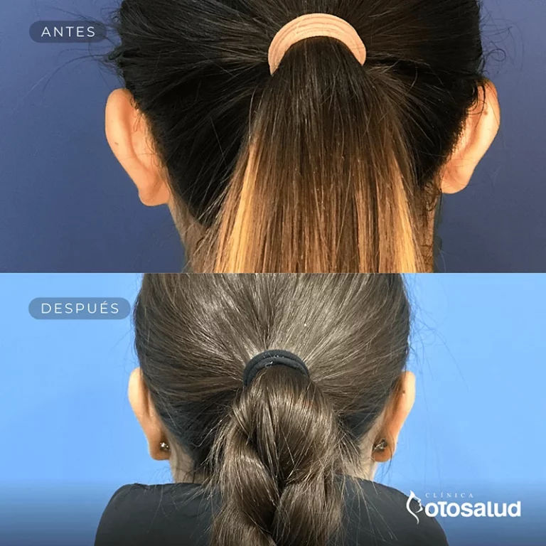 Otoplastia. Antes y Después