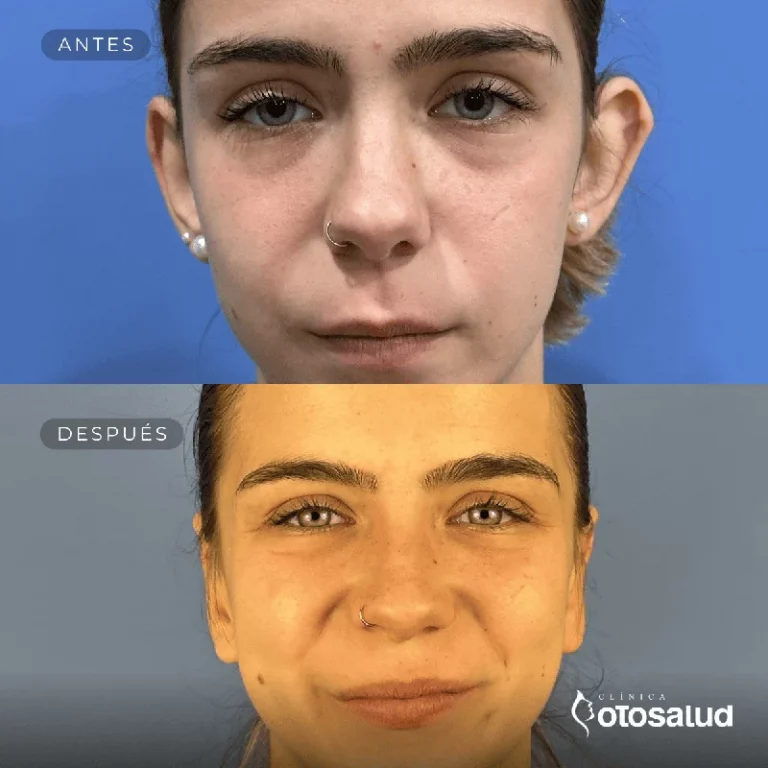 Otoplastia. Antes y Después