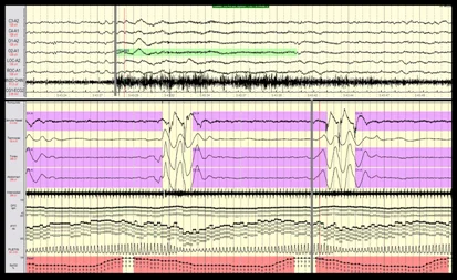 Unidad del sueño. Polisomnografía