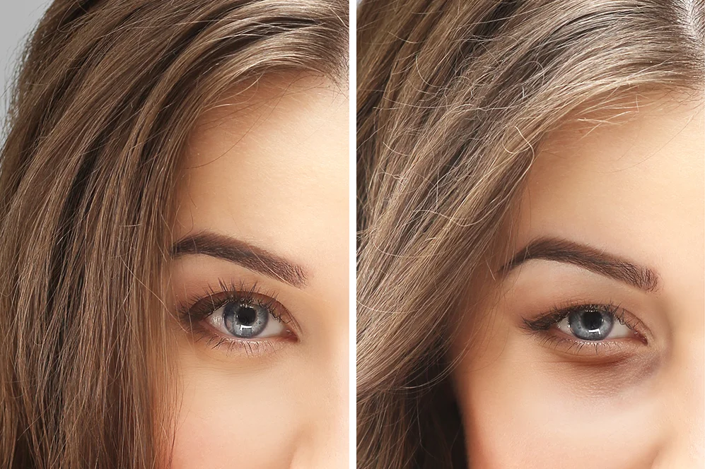 eliminacion ojeras sin cirugia